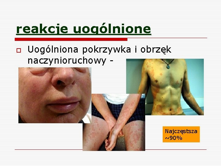 reakcje uogólnione o Uogólniona pokrzywka i obrzęk naczynioruchowy - Najczęstsza ~90% 