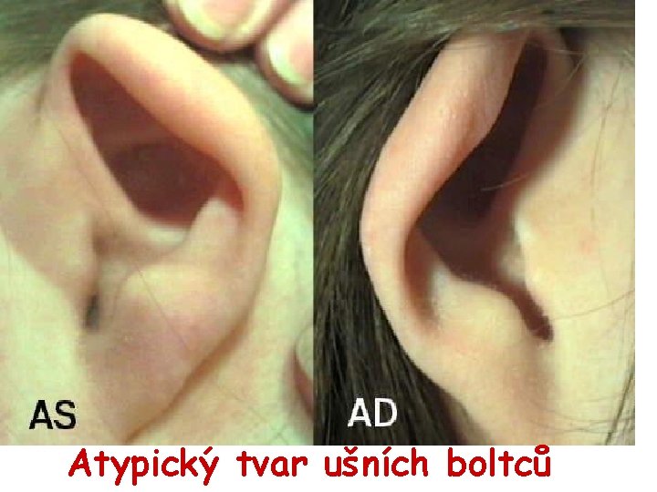 Atypický tvar ušních boltců 