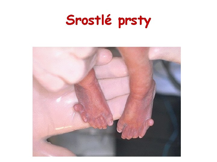 Srostlé prsty 