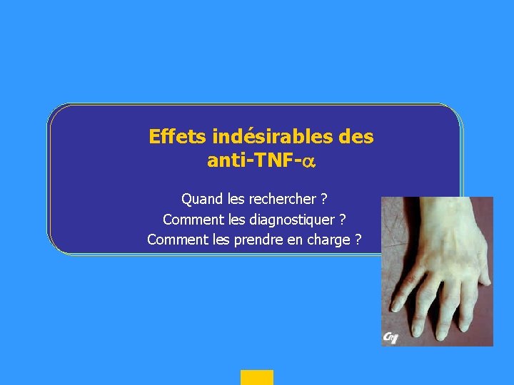 Effets indésirables des anti-TNF- Quand les recher ? Comment les diagnostiquer ? Comment les