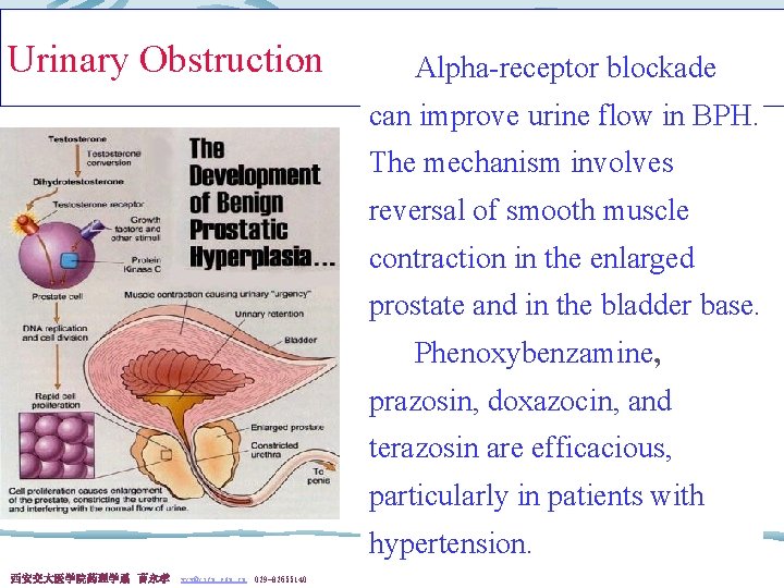 Urinary Obstruction Alpha-receptor blockade can improve urine flow in BPH. The mechanism involves reversal