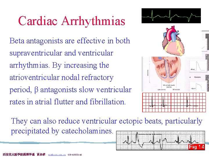 Cardiac Arrhythmias Beta antagonists are effective in both supraventricular and ventricular arrhythmias. By increasing