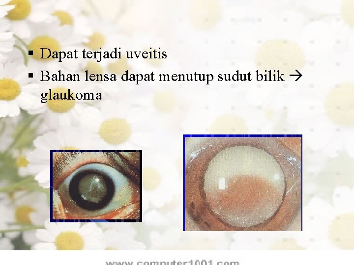 § Dapat terjadi uveitis § Bahan lensa dapat menutup sudut bilik glaukoma 