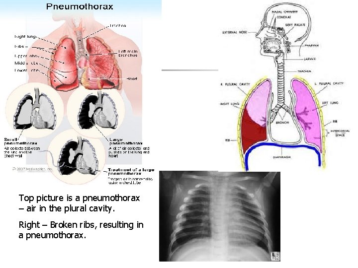 Top picture is a pneumothorax – air in the plural cavity. Right – Broken