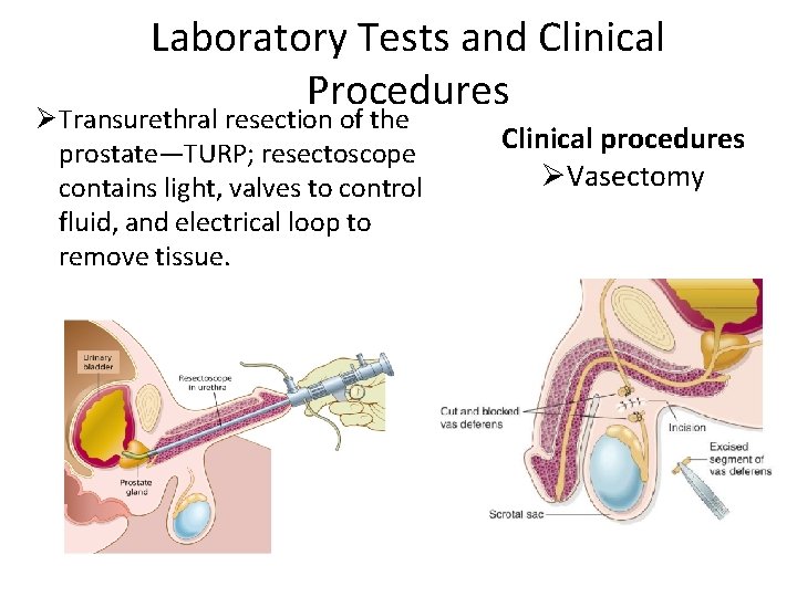 Laboratory Tests and Clinical Procedures Ø Transurethral resection of the prostate—TURP; resectoscope contains light,