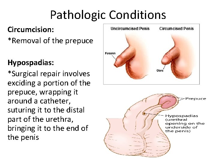 Pathologic Conditions Circumcision: *Removal of the prepuce Hypospadias: *Surgical repair involves exciding a portion