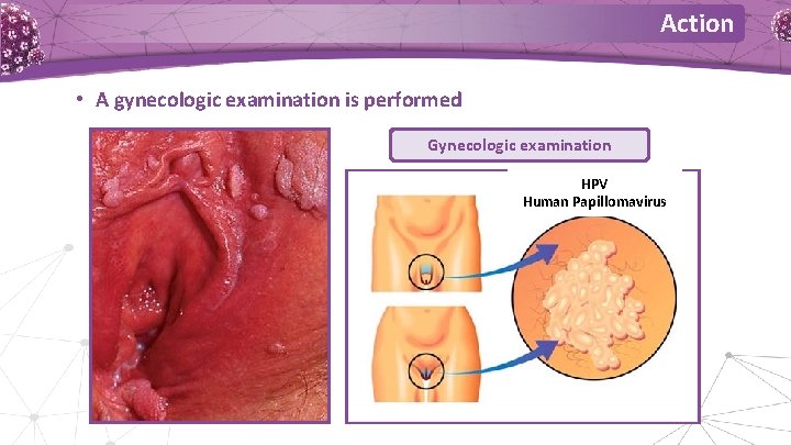 Action • A gynecologic examination is performed Gynecologic examination HPV Human Papillomavirus Action • A gynecologic examination is performed Gynecologic examination HPV Human Papillomavirus