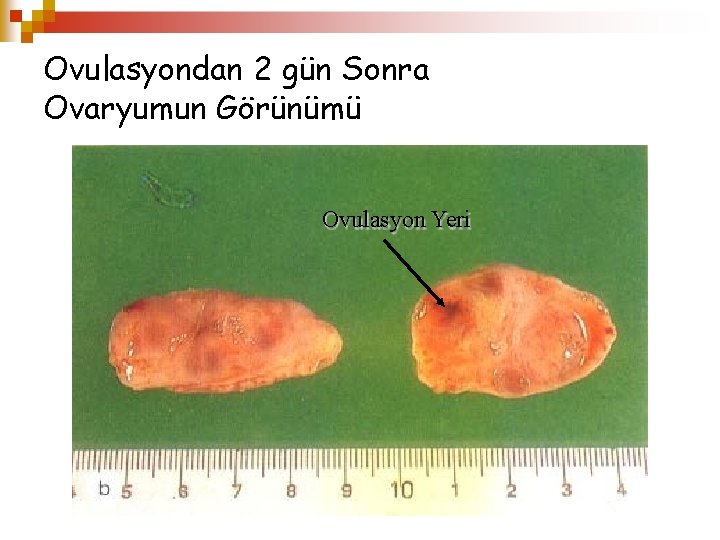 Ovulasyondan 2 gün Sonra Ovaryumun Görünümü Ovulasyon Yeri 