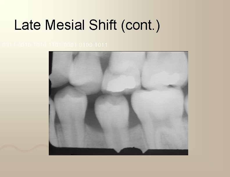 Late Mesial Shift (cont. ) 