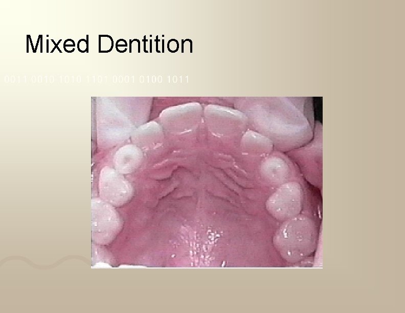 Mixed Dentition 