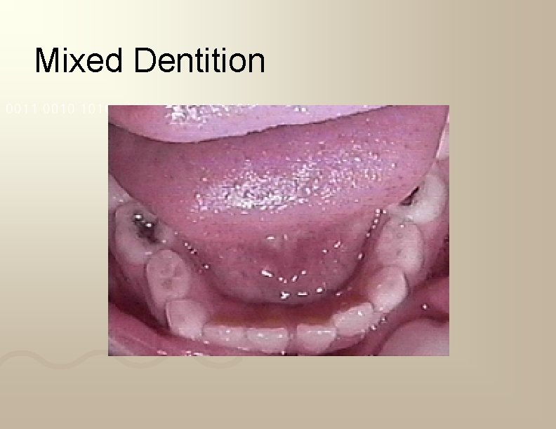 Mixed Dentition 