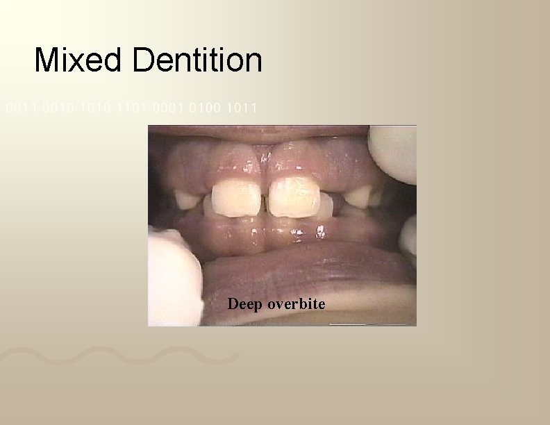 Mixed Dentition Deep overbite 