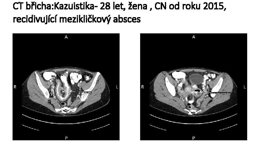 CT břicha: Kazuistika- 28 let, žena , CN od roku 2015, recidivující mezikličkový absces