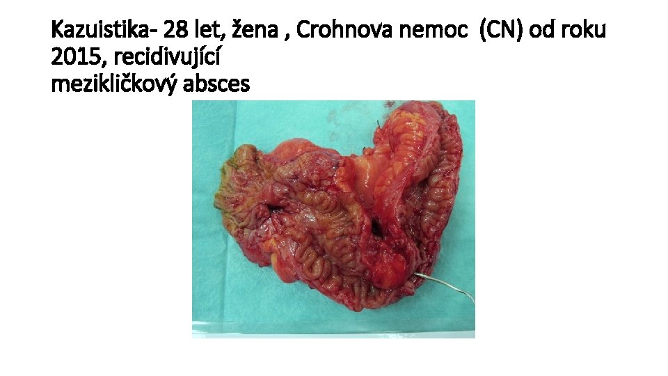 Kazuistika- 28 let, žena , Crohnova nemoc (CN) od roku 2015, recidivující mezikličkový absces