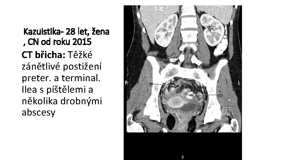 Kazuistika- 28 let, žena , CN od roku 2015 CT břicha: Těžké zánětlivé postižení