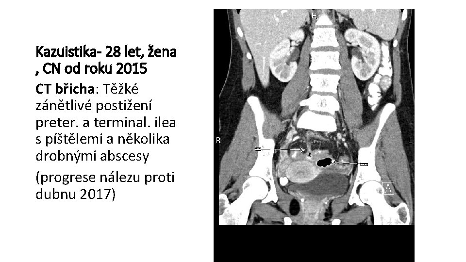 Kazuistika- 28 let, žena , CN od roku 2015 CT břicha: Těžké zánětlivé postižení