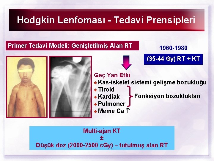 Hodgkin Lenfoması - Tedavi Prensipleri Primer Tedavi Modeli: Genişletilmiş Alan RT 1960 -1980 (35