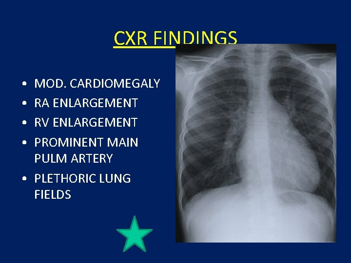 CXR FINDINGS • • MOD. CARDIOMEGALY RA ENLARGEMENT RV ENLARGEMENT PROMINENT MAIN PULM ARTERY