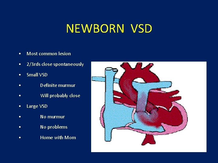 NEWBORN VSD • Most common lesion • 2/3 rds close spontaneously • Small VSD