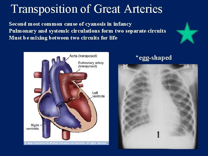 Transposition of Great Arteries Second most common cause of cyanosis in infancy Pulmonary and