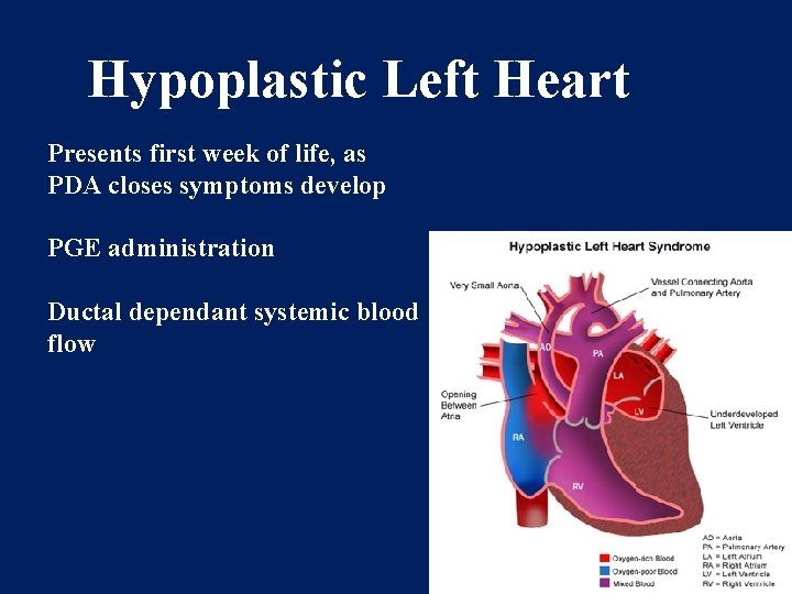 Hypoplastic Left Heart Presents first week of life, as PDA closes symptoms develop PGE