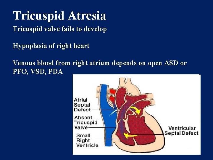 Tricuspid Atresia Tricuspid valve fails to develop Hypoplasia of right heart Venous blood from