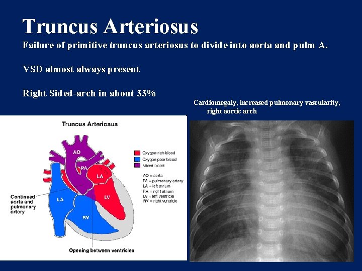 Truncus Arteriosus Failure of primitive truncus arteriosus to divide into aorta and pulm A.