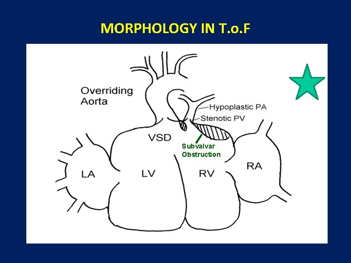 MORPHOLOGY IN T. o. F Subvalvar Obstruction 