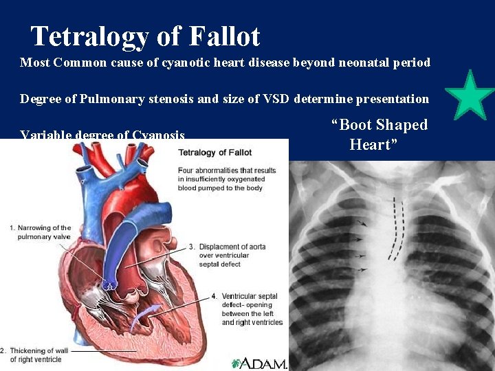 Tetralogy of Fallot Most Common cause of cyanotic heart disease beyond neonatal period Degree