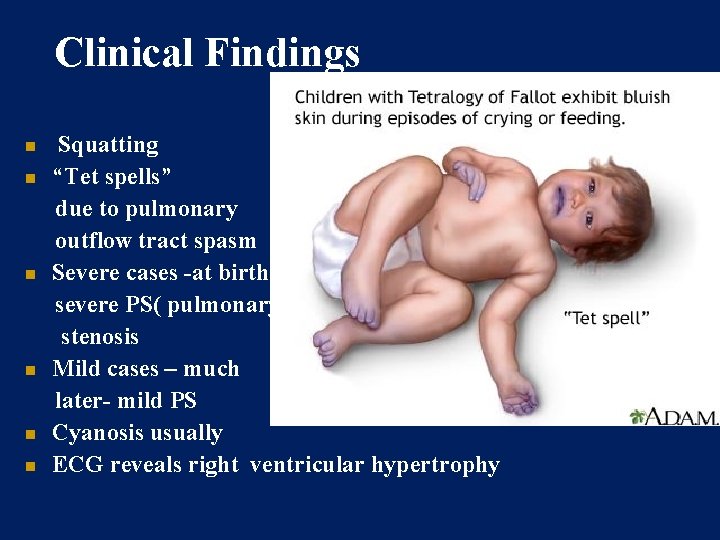 Clinical Findings Squatting “Tet spells” due to pulmonary outflow tract spasm Severe cases -at