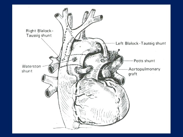 Systemic to Pulmonary Shunts 