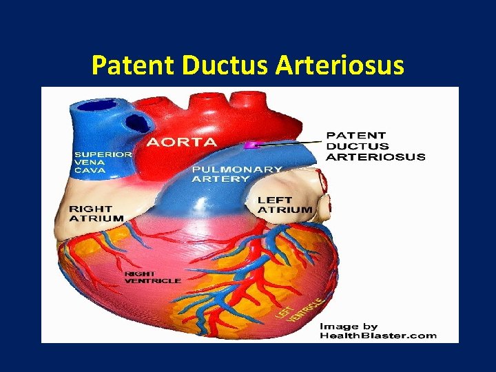 Patent Ductus Arteriosus 