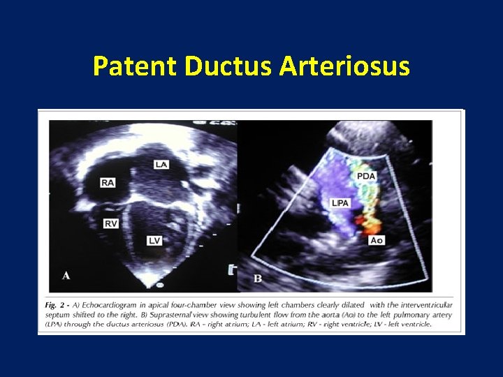 Patent Ductus Arteriosus 