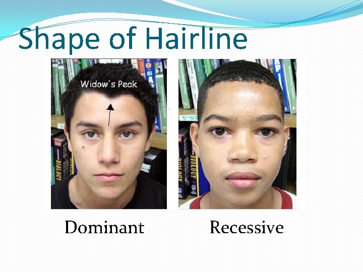 Shape of Hairline Dominant Recessive 