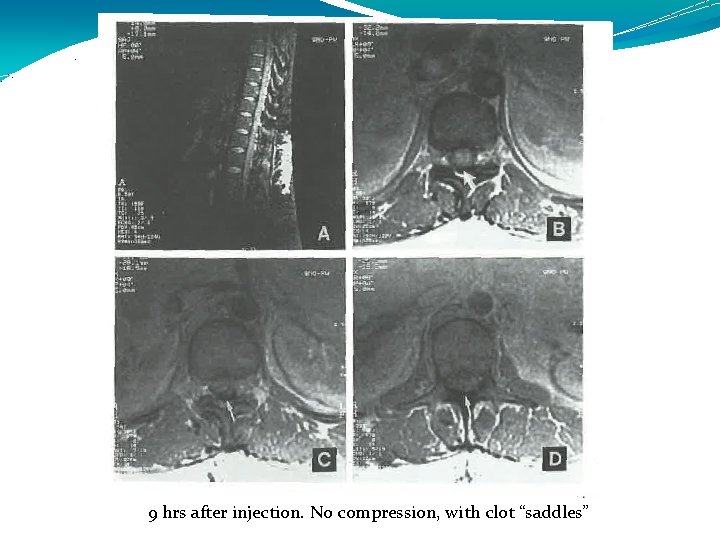 9 hrs after injection. No compression, with clot “saddles” 