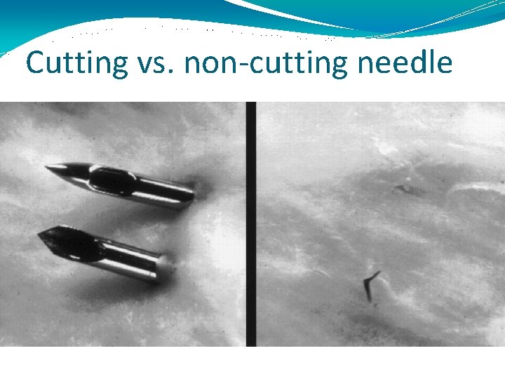 Cutting vs. non-cutting needle 