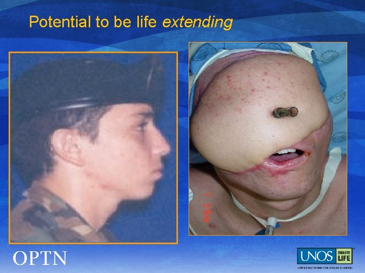 Potential to be life extending 