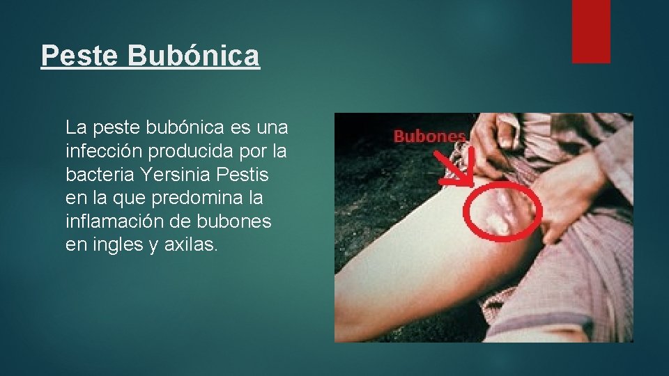 Peste Bubónica La peste bubónica es una infección producida por la bacteria Yersinia Pestis