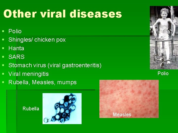 Other viral diseases § § § § Polio Shingles/ chicken pox Hanta SARS Stomach