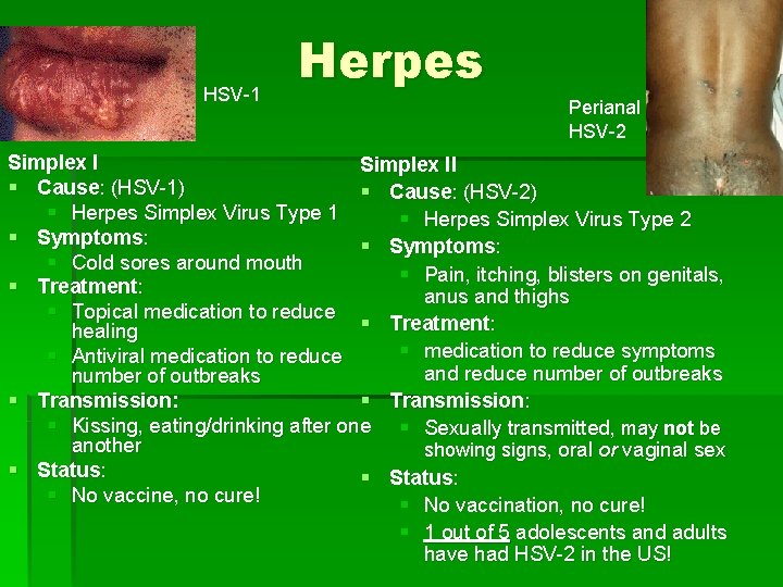 HSV-1 Herpes Perianal HSV-2 Simplex II § Cause: (HSV-1) § Cause: (HSV-2) § Herpes