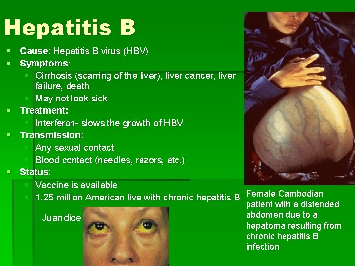 Hepatitis B § Cause: Hepatitis B virus (HBV) § Symptoms: § Cirrhosis (scarring of