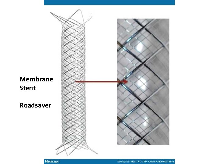 Membrane Stent Roadsaver 