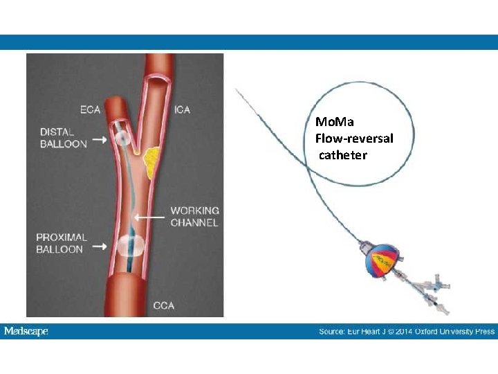 Mo. Ma Flow-reversal catheter 