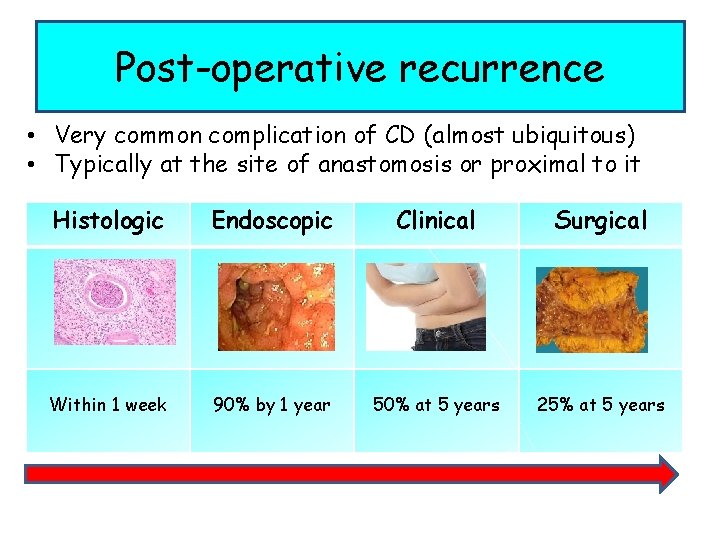 Post-operative recurrence • Very common complication of CD (almost ubiquitous) • Typically at the