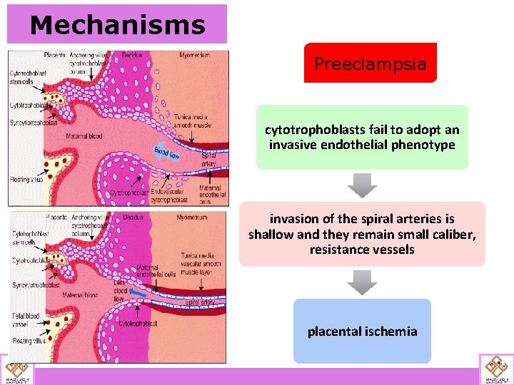 Mechanisms Preeclampsia cytotrophoblasts fail to adopt an invasive endothelial phenotype invasion of the spiral