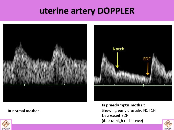 uterine artery DOPPLER In normal mother In preeclamptic mother: Showing early diastolic NOTCH Decreased