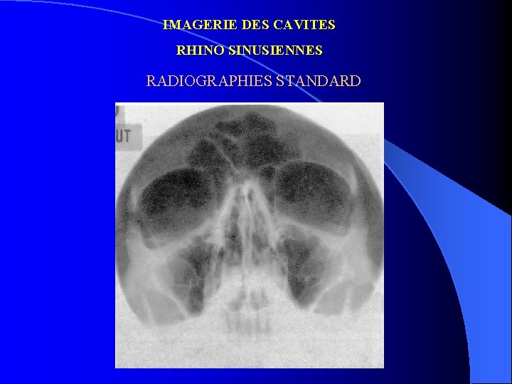 IMAGERIE DES CAVITES RHINO SINUSIENNES RADIOGRAPHIES STANDARD 