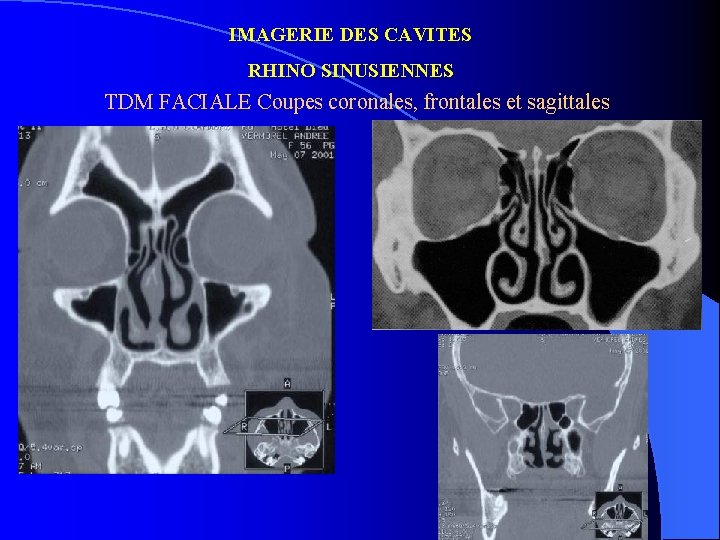 IMAGERIE DES CAVITES RHINO SINUSIENNES TDM FACIALE Coupes coronales, frontales et sagittales 
