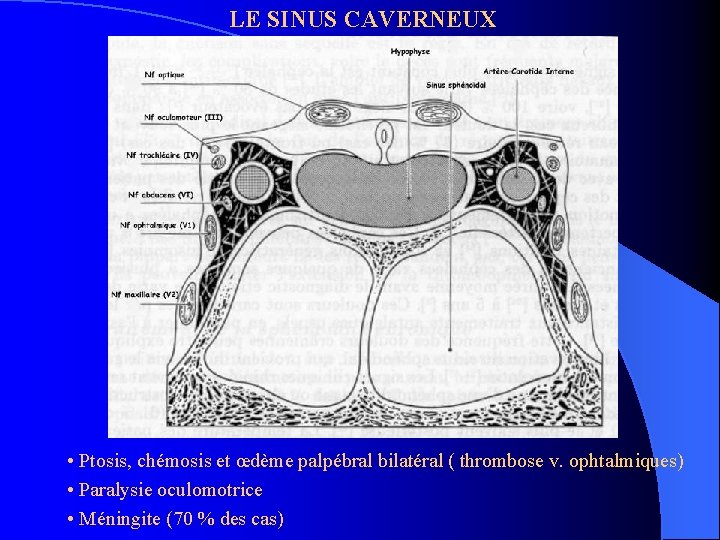 LE SINUS CAVERNEUX • Ptosis, chémosis et œdème palpébral bilatéral ( thrombose v. ophtalmiques)