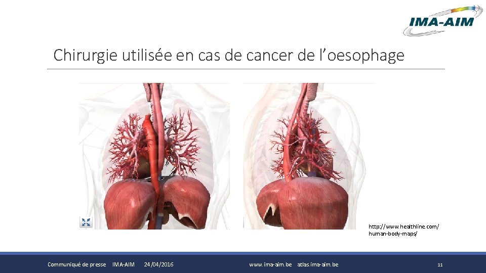 Chirurgie utilisée en cas de cancer de l’oesophage http: //www. healthline. com/ human-body-maps/ Communiqué